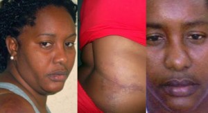 Tres fotos de Damaris Moya mostrando golpes y heridas provocadas por la policia politica cubana.