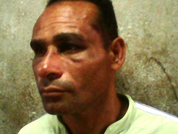 Golpes en el rostro de Roelvis Cuba Sendó después de las golpizas del 6 y 10 de diciembre (foto del autor)