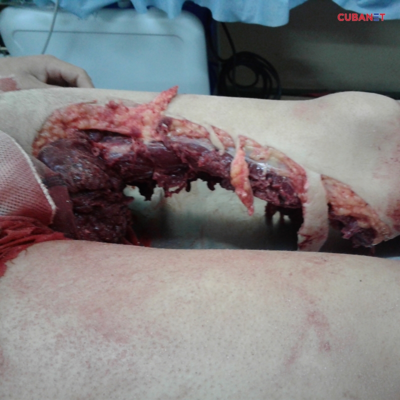 Squalo killer morde mortalmente un giovane holguinero che faceva il bagno di notte presso playa Guardalavaca Mordida_tiburon_1