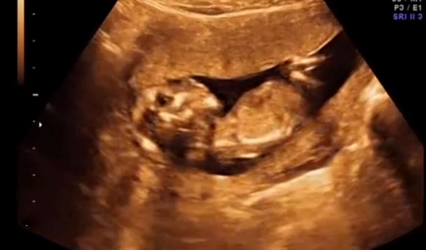 aborto cuba